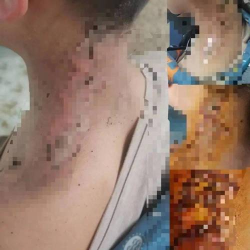 男孩玩鞭炮9级伤残,男童玩鞭炮手炸伤